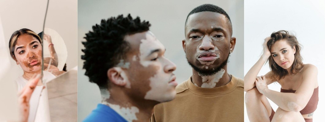 Vitiligo Hastalığı: Nedenleri, Belirtileri ve Tedavisi