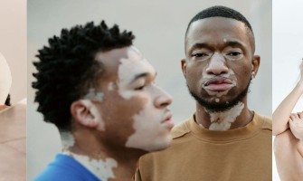 Vitiligo Hastalığı: Nedenleri, Belirtileri ve Tedavisi